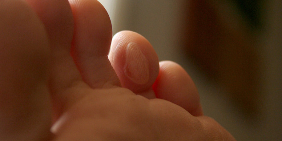 Une ampoule sur un doigt de pied.